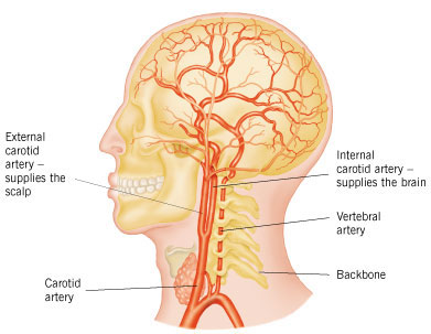 Stroke سکته مغزی (1)