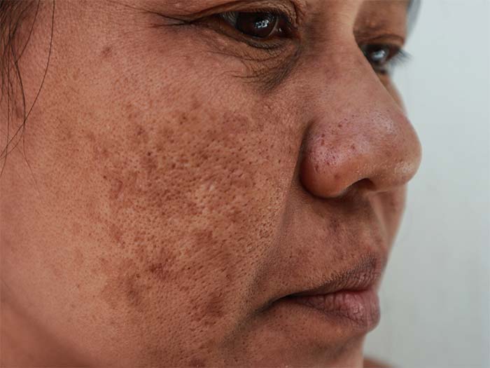 آسیب‌های پوستی و PIH (Post-Inflammatory Hyperpigmentation)