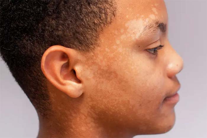 عفونت‌های قارچی و مخمری (لکه‌های روشن)