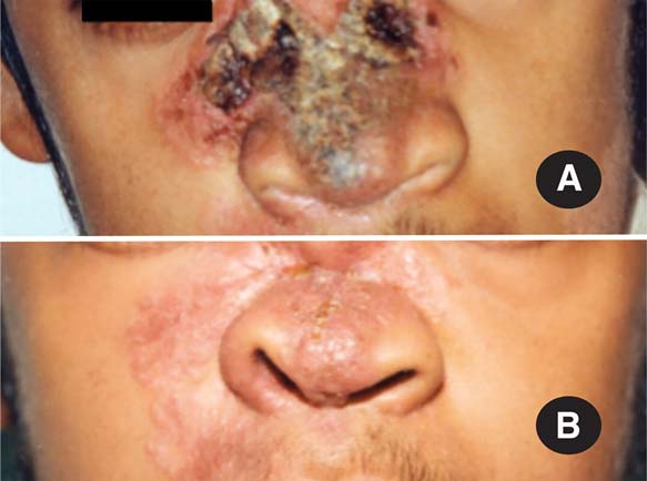موکورمایکوزیس یا قارچ سیاه (Mucormycosis)