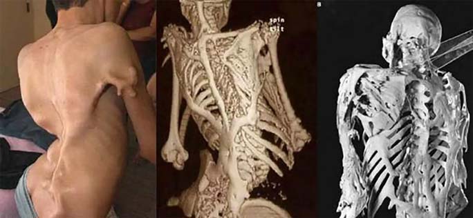 سندروم مرد سنگی (Fibrodysplasia Ossificans Progressiva)