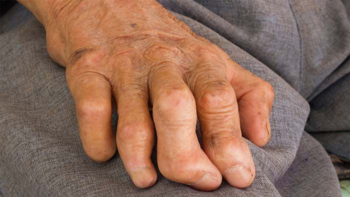 جذام (Leprosy)