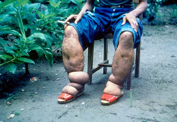 بیماری فیل‌پایی (Elephantiasis)