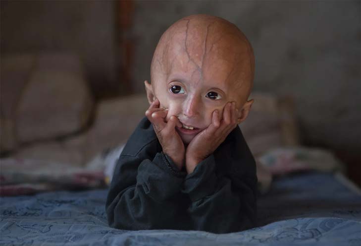 پروجریا (Progeria)